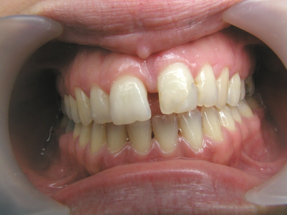 Exploración periodontal con sondaje en el Centro Médico Schilman