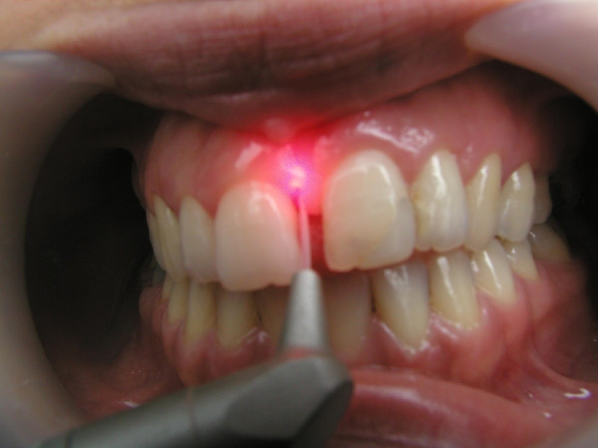 Trabajo con láser en el margen gingival, Centro Médico Schilman