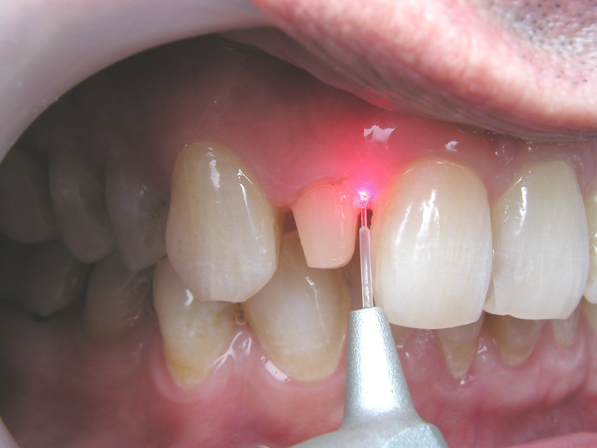 Tratamiento de encías con láser en el Centro Médico Schilman, Ramat HaSharón