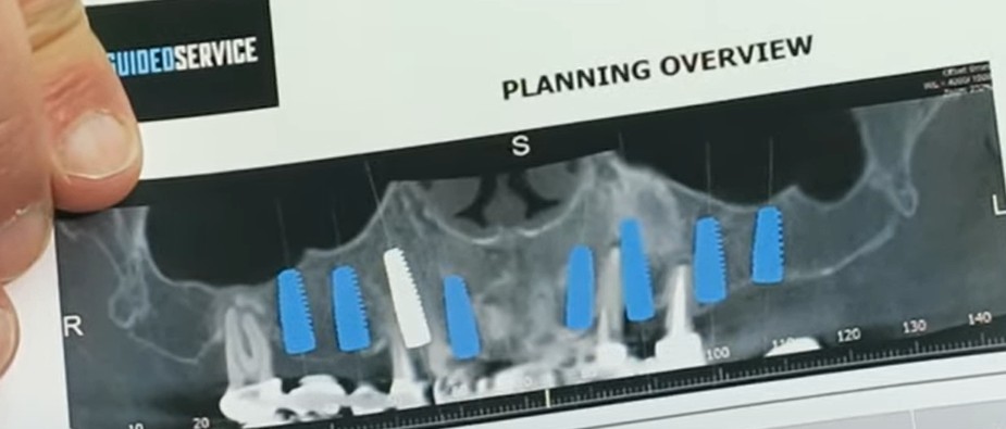 תכנון דיגיטלי של מיקומי שתלים על בסיס סריקת CBCT, מרכז רפואי שילמן